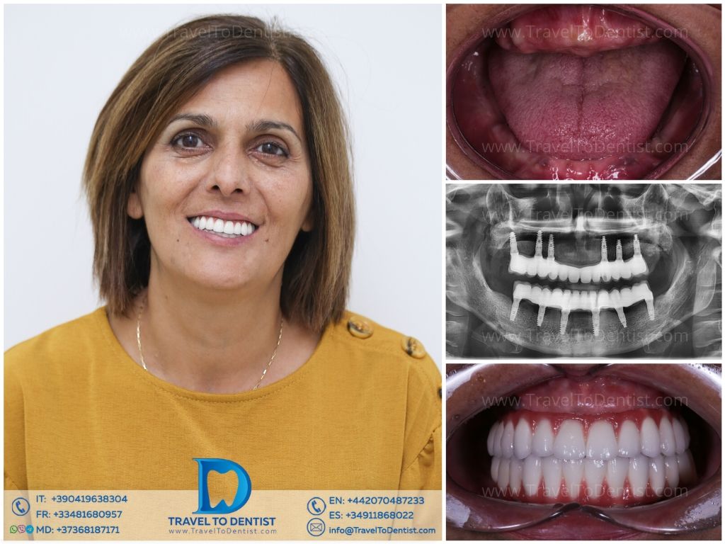Caso 5 — Transformación dental